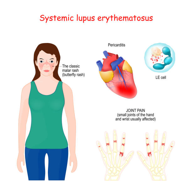 Systemic lupus erythematosus (SLE) Systemic lupus erythematosus. SLE or lupus, is a autoimmune disease. Woman with red spot on her face in shape of butterfly. Vector illustration pericarditis stock illustrations