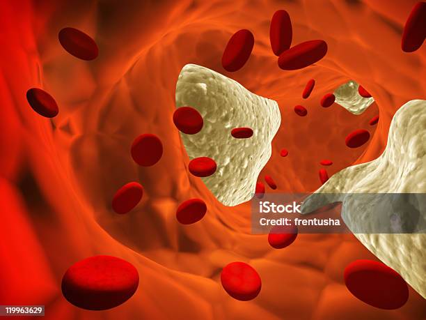 Aterosclerosis Foto de stock y más banco de imágenes de Colesterol - Colesterol, Coágulo de sangre, Ilustración biomédica