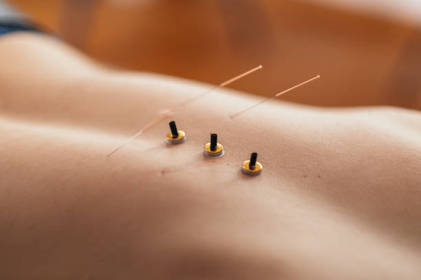 istock Acupuncture and moxibustion treatment 1199873178