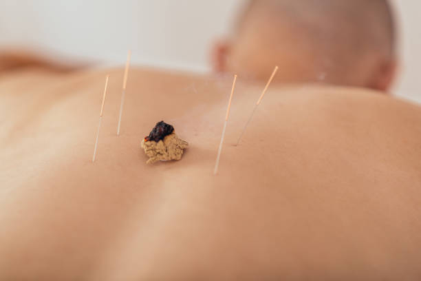 istock Acupuncture and moxibustion treatment 1199877389