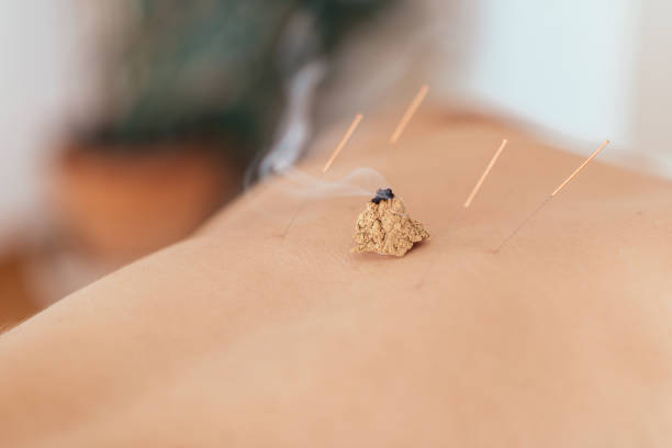 istock Acupuncture and moxibustion treatment 1199877395
