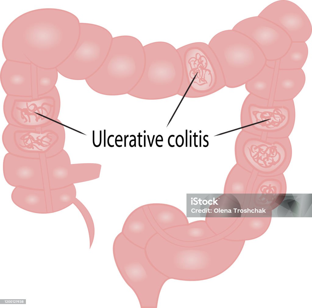 Colitis Colon Ulcerative Colitis Intestine Disease Stock Illustration - Download ...