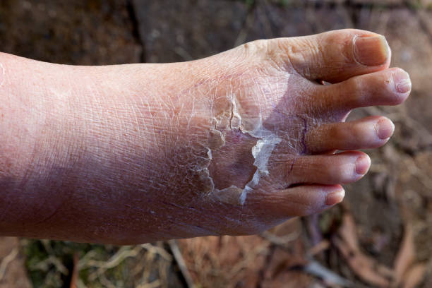 Cellulitis on leg and foot of mature diabetic man in daylight outdoors stock photo