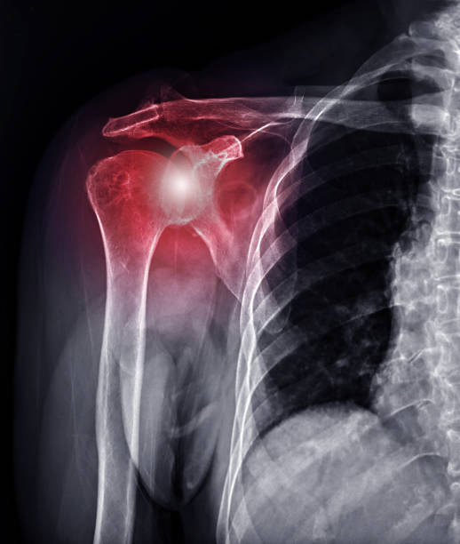 l'articulation d'épaule de rayon x pour la dislocation d'articulation d'épaule de diagnostic. - x ray x ray image shoulder human arm photos et images de collection