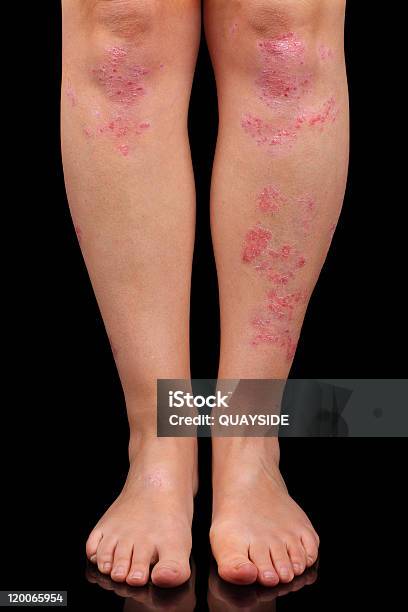 Legs From Knees To Toes Showing Pink And Patchy Psoriasis Stock Photo - Download Image Now