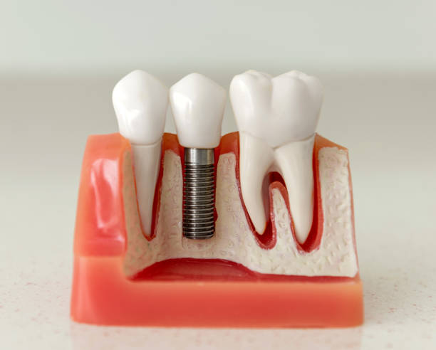 istock Dental model with implantation 1200694482