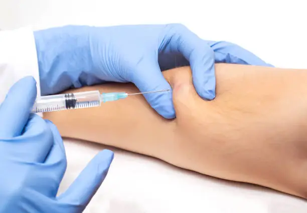 Photo of The doctor uses a syringe to take a skin biopsy from the patient. The concept of malignant subcutaneous lesions, close-up