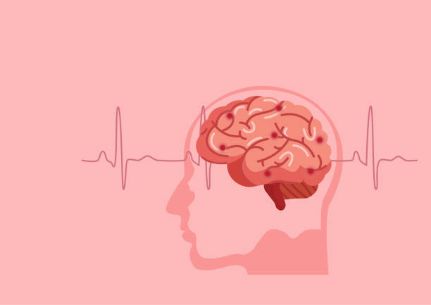 Stroke Patient Illustrations, Royalty-Free Vector Graphics & Clip Art - iStock Stroke Patient Illustrations, Royalty-Free Vector Graphics & Clip Art - iStock