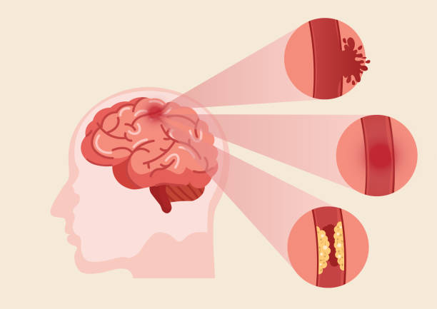 Mental Health Concept Stock Illustration - Download Image Now - Stroke -  Illness, Headache, Mental Health - iStock