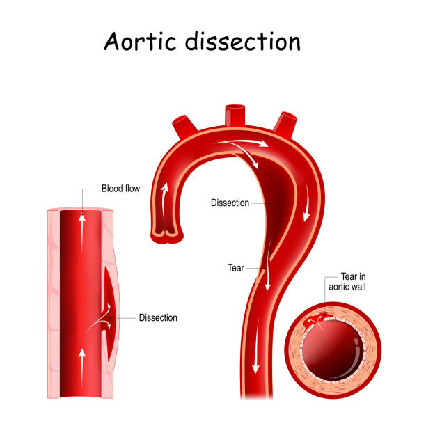 illustrazioni stock, clip art, cartoni animati e icone di tendenza di dissezione aortica - aorta