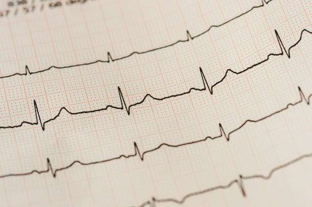 istock Detail Of Cardiogram Chart (ECG) 1200930911