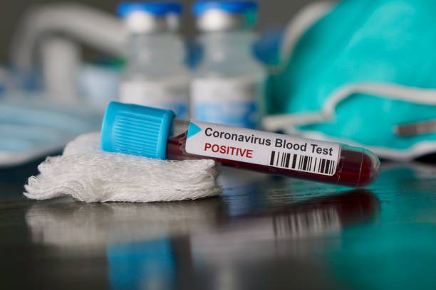 resultado positivo do exame de sangue para a nova propagação rápida do coronavirus, originário de wuhan, china - specimen holder fotos - fotografias e filmes do acervo