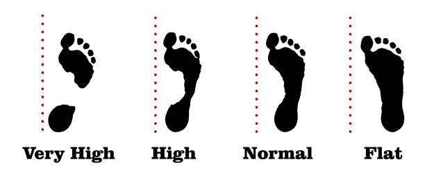 istock Flatfoot. 4 footprints of a person with varying degrees of flat feet. Vector 1201181325