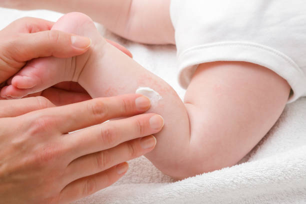 婦女手抱著嬰兒腿。母親小心地塗抹藥膏。來自奶粉或其他食物的紅幹皮膚過敏。關心寶寶的身體。特寫。 - 濕疹 個照片及圖片檔