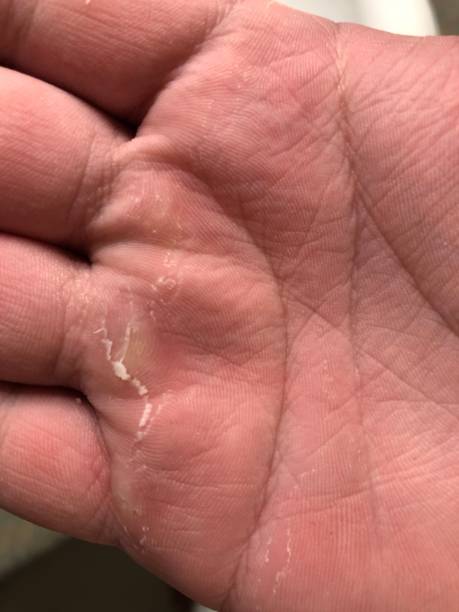 istock A mans callused hands that ripped during weight lifting 1201219959