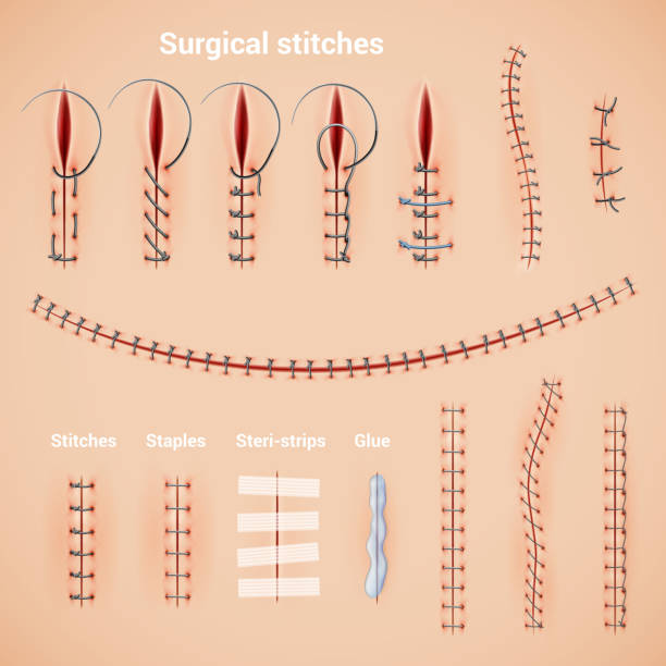 illustrazioni stock, clip art, cartoni animati e icone di tendenza di punti di sutura chirurgica set realistico - brilliant cut