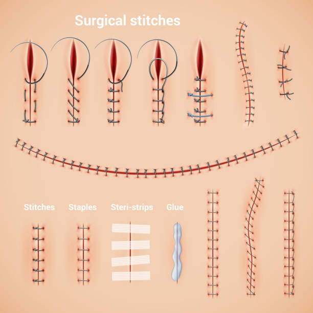 surgical suture stitches realistic set Surgical suture stitches realistic set of stitching methods and shapes with staples glue and text captions vector illustration scar stock illustrations