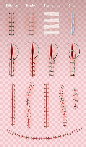 surgical suture stitches realistic transparent set Surgical suture stitches realistic set of images on transparent background with different shapes of medical stitching vector illustration scar stock illustrations