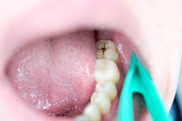 噛む歯、虫歯、審美的欠陥に関する気まぐれな病変 - 歯垢 ストックフォトと画像