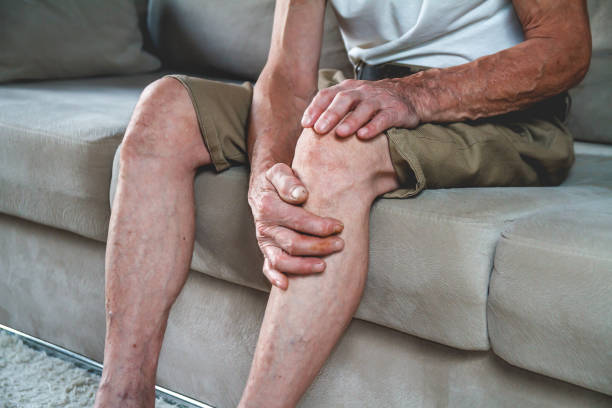 Knee pain in an elderly man Pain in the legs and knees of an elderly senior. An old man massages his knees due to severe pain from arthritis and varicose veins varicose vein stock pictures, royalty-free photos & images