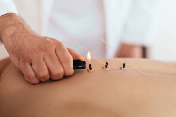 istock Therapist perform moxibustion treatment 1201397499