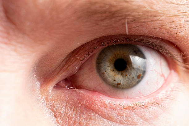 istock Sore eye with suppuration on eyelashes close up 1201409156