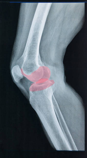 primer plano de rayos x de rodilla humana - cruciate ligament fotografías e imágenes de stock