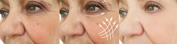 istock face elderly woman face wrinkles before and after treatment 1201515687