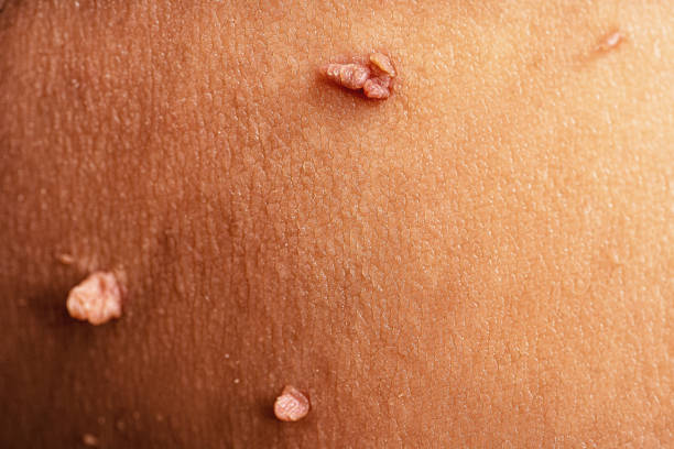 skin-tag oder acrochordon oder weiches fibrom oder maulwurf in männlicher achselhöhle, makrofoto. papilloma-virus oder beulen, dermatologie-problem auf hautkonzept - warze stock-fotos und bilder