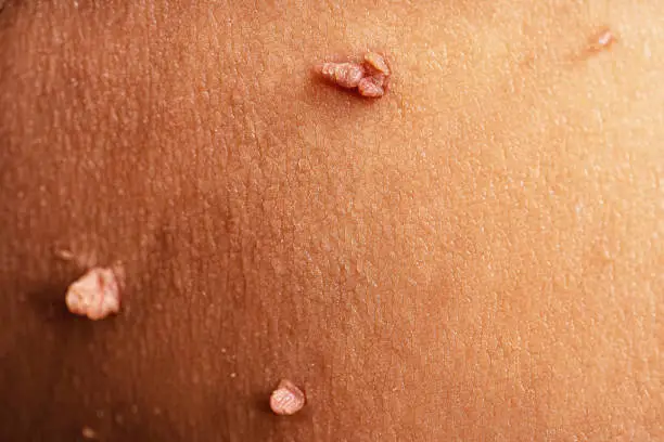 Skin tag or acrochordon or soft fibroma or mole in male armpit, macro photo. Papilloma virus or bump, dermatology problem on skin concept.