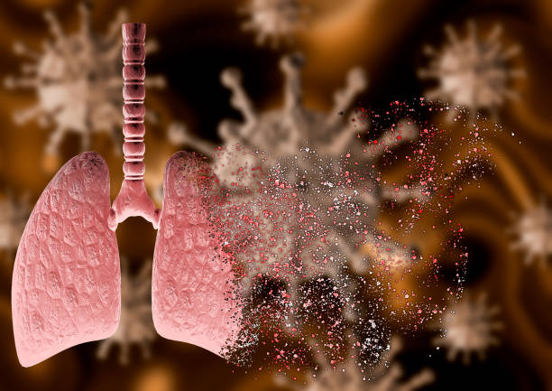 coronavirus attacking lung with severe pneumonia disintegrating it, leading to death stock photo