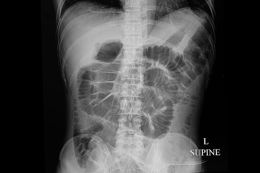 x-ray film of a patient with bowel obstruction