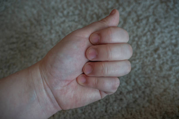 daño de morderse las uñas por trastornos de estrés y ansiedad. cutículas dañadas y puntas amarillas de las uñas. imagen conceptual de la depresión, la adicción y las dolencias médicas - nail biting biting fingernail obsessive fotografías e imágenes de stock