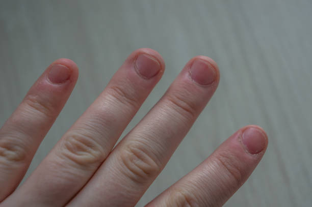 uñas de los dedos extremadamente dañadas con cutículas hinchadas por morderse las uñas debido a la ansiedad y el trastorno compulsivo.  imagen conceptual para el estrés, la adicción o la recolección de la piel. - nail biting biting fingernail obsessive fotografías e imágenes de stock