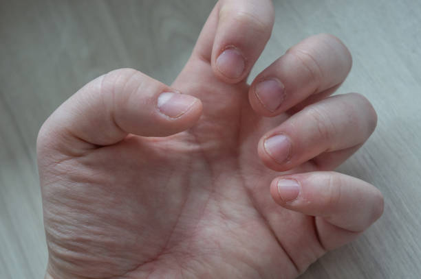 istock Bitten fingernails damaged due to anxiety disorders with damaged cuticles from skin picking. Conceptual for stress, depression or medical purposes. 1201654864