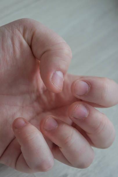 istock Bitten fingernails damaged due to anxiety disorders with damaged cuticles from skin picking. Conceptual for stress, depression or medical purposes. 1201654880