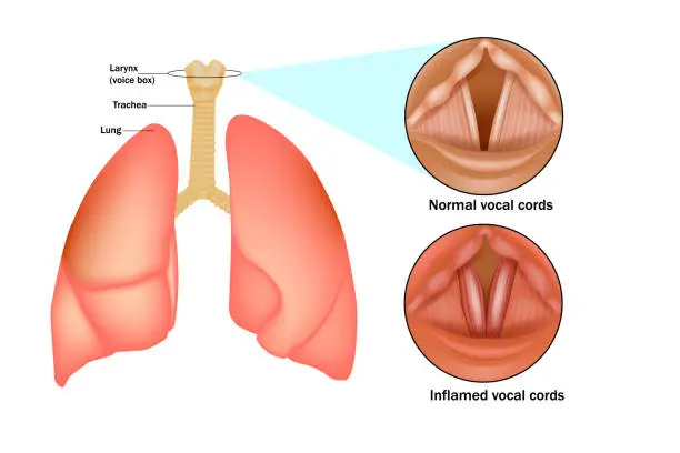 Vector illustration of Croup (laryngo-tracheo-bronchitis).