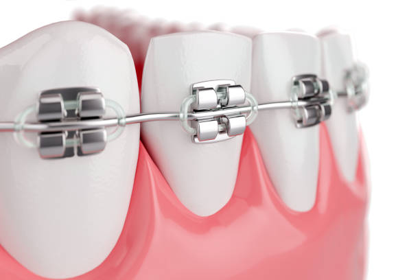 close up beauty health teeth with brace. selective focus. 3d render. - dental equipment imagens e fotografias de stock