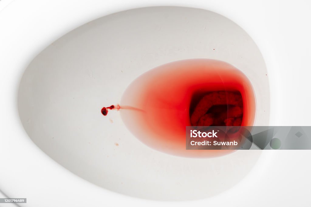 Blood Clots Mixed With The Feces Of People With Hemorrhoids In A White