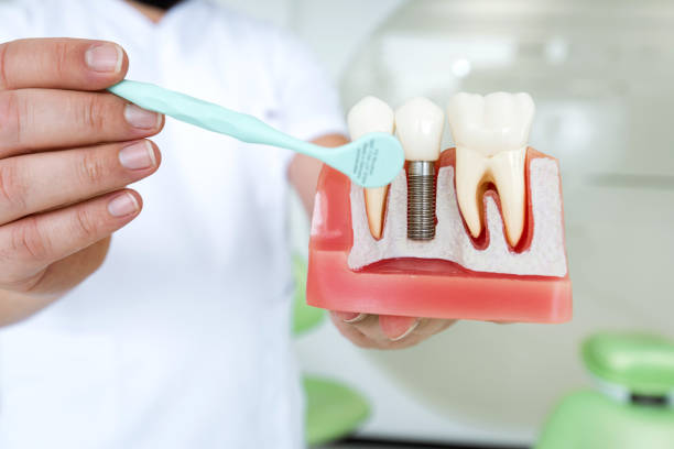 Male Dentist Explaining Tooth Implantation stock photo