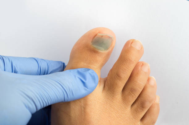 doctor checking the left foot toe nail suffering from subungual hematoma blue Closeup image of doctor checking the left foot toe nail suffering from subungual hematoma blue and black toe nail hematoma images stock pictures, royalty-free photos & images