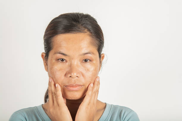 istock spot melasma dark and freckles 1201938767