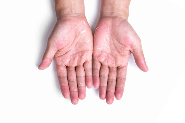 istock Dry hands, peel, Dermatitis.Allergic to chemicals.Eczema 1201969809