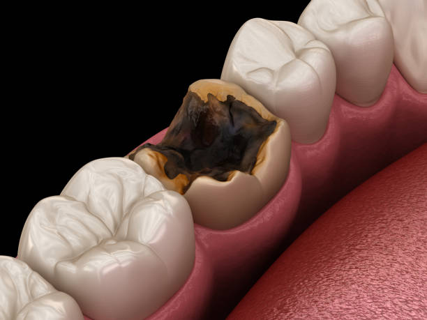 istock Molar tooth damaged by caries. Medically accurate tooth 3D illustration. 1202019487