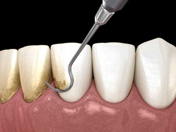 istock Oral hygiene: Scaling and root planing (conventional periodontal therapy). Medically accurate 3D illustration of human teeth treatment 1202019516