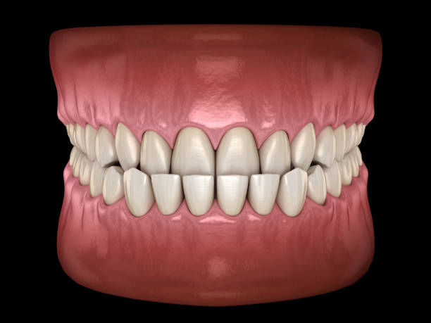 unterbiß dental okklusion (malokklusion der zähne). medizinisch genaue zahn 3d-illustration - fehlbiss stock-fotos und bilder