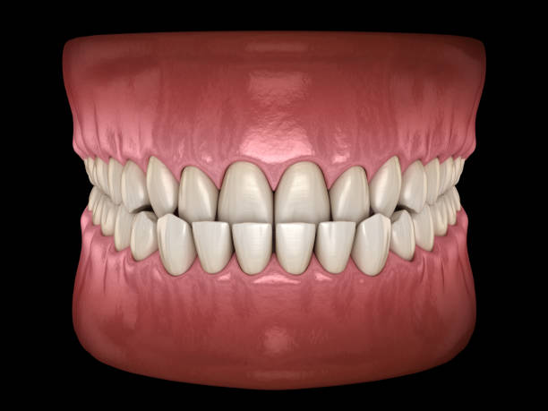 istock Underbite dental occlusion ( Malocclusion of teeth ). Medically accurate tooth 3D illustration 1202019547