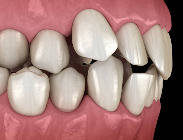 Inconistent Teeth 190+ Misaligned Teeth Stock Photos, Pictures & Royalty-Free Images - iStock