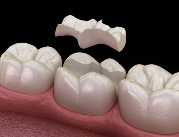 istock Inlay ceramic crown fixation over tooth. Medically accurate 3D illustration of human teeth treatment 1202019632