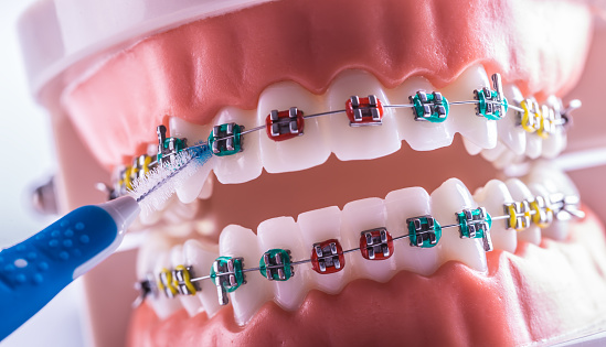 Tooth model from dental braces with inter dental teeth cleaning brush.